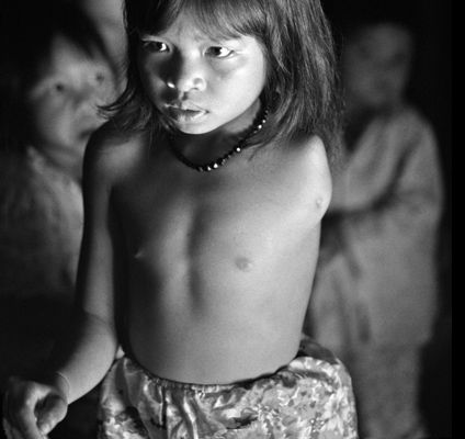 Quynh Lan, 11 years old, at her home in A Luoi. Her father was sprayed many times